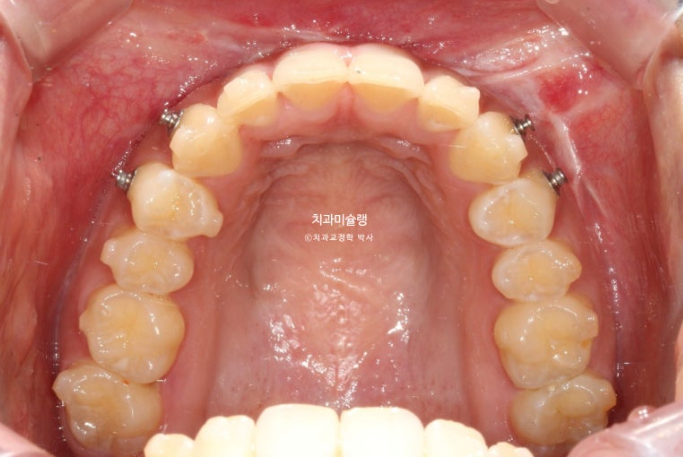 선수술 양악수술 비대칭 주걱턱 잇몸미소 치료 인비절라인 라이트 관련 이미지 9