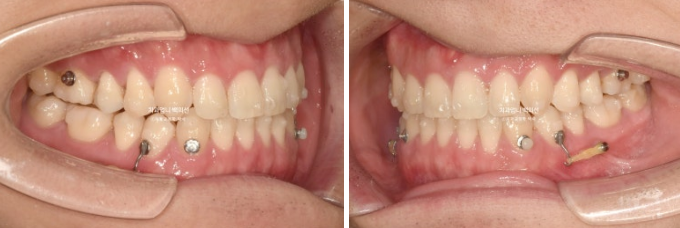 MSE Palatal Expansion Invisalign Underbite Correction, Non-Surgical image 11