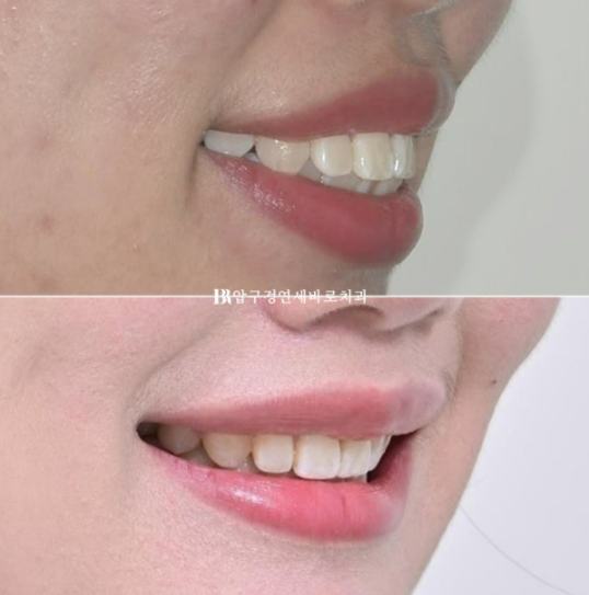 A Review of Extraction Orthodontic Treatment for Protruding Mouth | The Details of Orthodontics That Transform Buccal Corridors and Smile Lines image 1