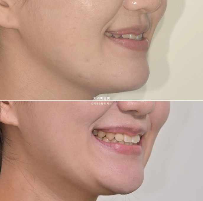 비발치 비수술 주걱턱 반대교합 재교정 치료 관련 이미지 17
