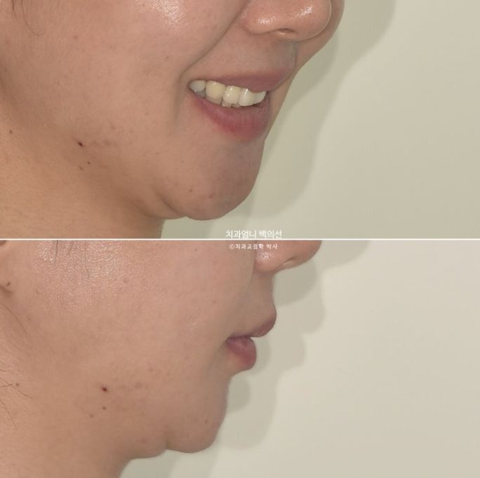 옥니 역교정 재교정 무턱 교정 치료기간 1년 10개월 관련 이미지 7