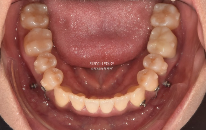 비발치 교정 덧니 인비절라인 교정 절단교합 반대교합 치료기간 1년 6개월 관련 이미지 14