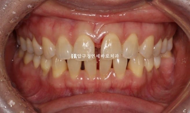 벌어진 치아 교정 인비절라인 라이트 무삭제 라미네이트 치료 관련 이미지 4
