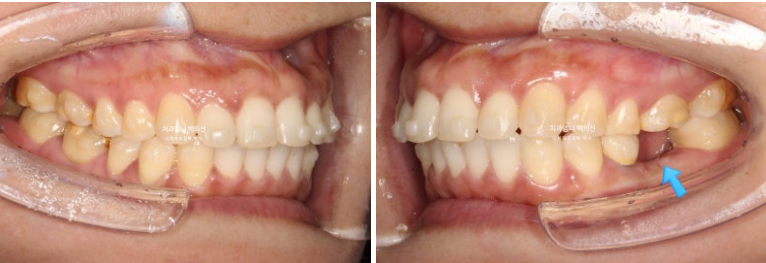40대 인비절라인 라이트 앞니 벌어짐 뻗침 돌출 치료 관련 이미지 11