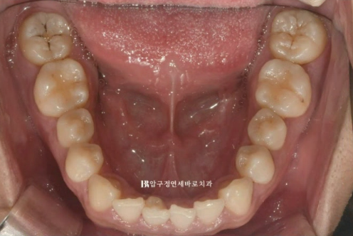 압구정 인비절라인 라이트 과개교합 후기 관련 이미지 5