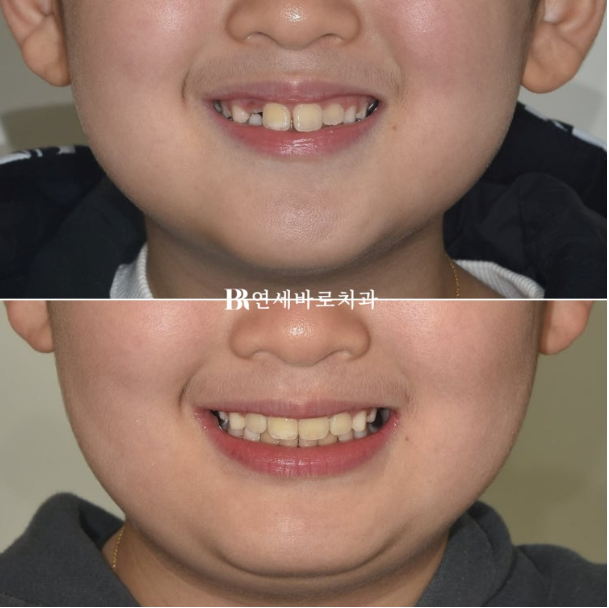 A Real Case of Preventing Crowded Teeth with Invisalign First for a Child in Gangnam image 8