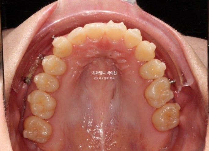 인비절라인 교정 비발치 비대칭 덧니 중심선 선천적 결손치 교정? 관련 이미지 11