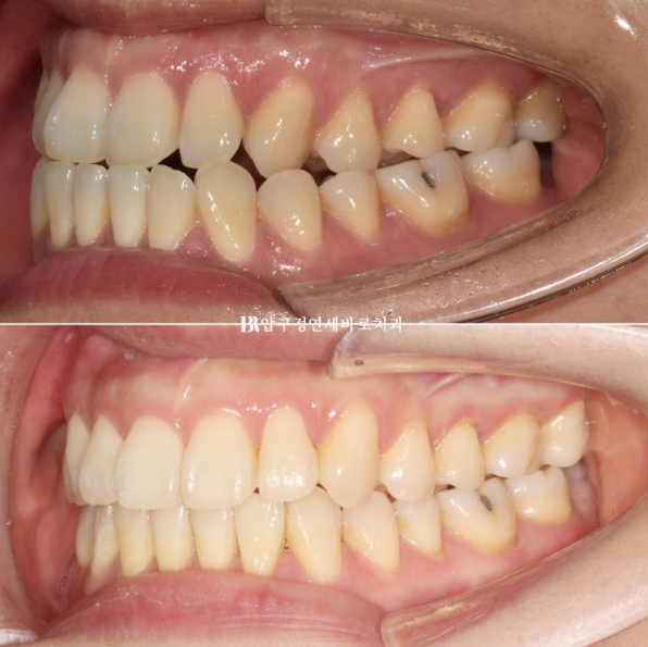 양악수술 선수술 교정 후기 인비절라인 교정 관련 이미지 14