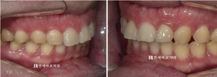 무삭제 라미네이트 아무곳에서 하지 마세요. 관련 이미지 3