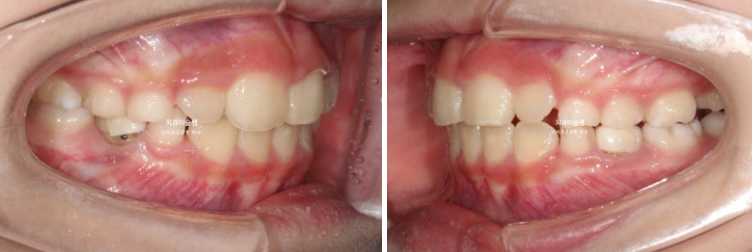 어린이 투명교정 인비절라인 퍼스트 과개교합 교정 후기 관련 이미지 9