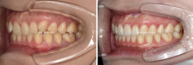 If Inward-Tilted Teeth Make Your Smile Look Constricted? Invisalign Before and After image 12