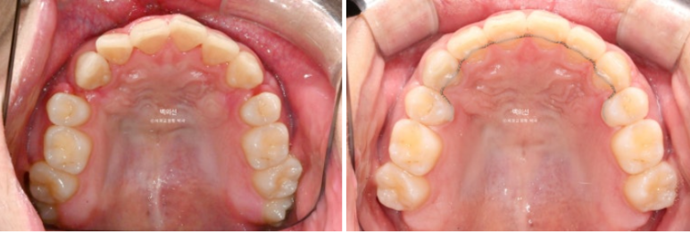 돌출입 수술 ASO + 인비절라인 라이트 후교정 치료기간 10개월 관련 이미지 14