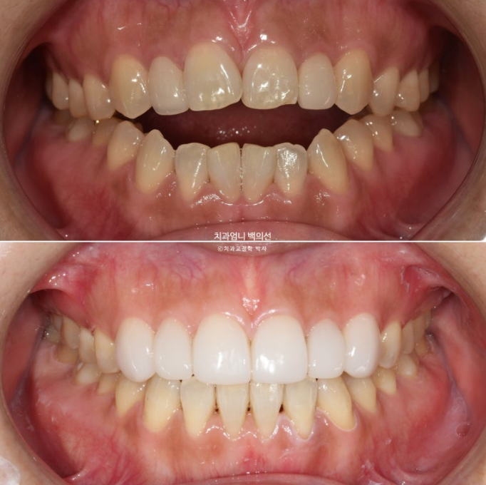 비수술 개방교합 클리피씨 30대 무삭제 라미네이트 치료기간 2년 관련 이미지 16