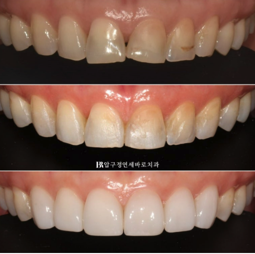 Laminate Veneers in Your 50s: Is It Possible Without Shaving Down the Teeth? | No-Prep Laminate Veneers + Real Case of Front Tooth Partial Orthodontics image 9