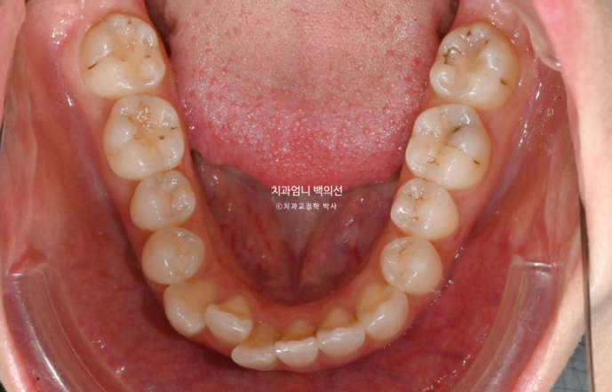 인비절라인 라이트 교정 앞니돌출 과개교합 덧니 교정 관련 이미지 3