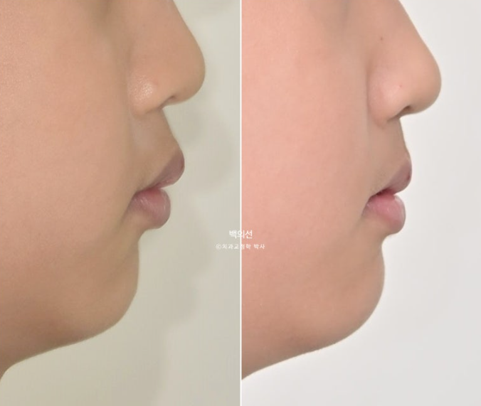 인비절라인퍼스트 어린이 투명교정 과개교합 덧니 악궁확장 돌출 관련 이미지 25