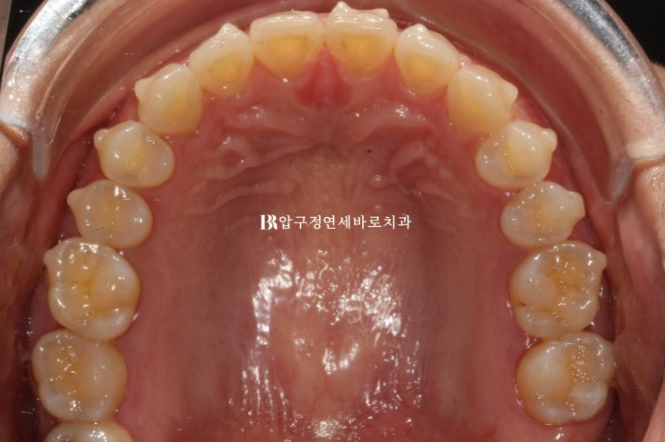 벌어진 치아 교정 인비절라인 라이트 무삭제 라미네이트 치료 관련 이미지 9