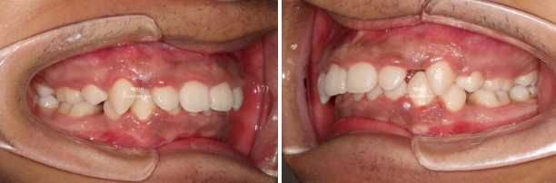 거미스마일 잇몸미소 발치 돌출입 과개교합 교정 후기 관련 이미지 3