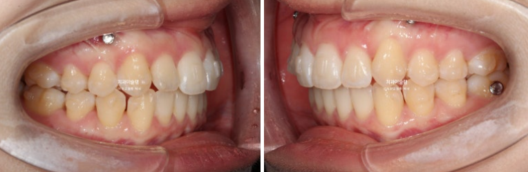 덧니 인비절라인 라이트 잇몸미소 거미스마일 중심선 블랙트라이앵글 관련 이미지 8