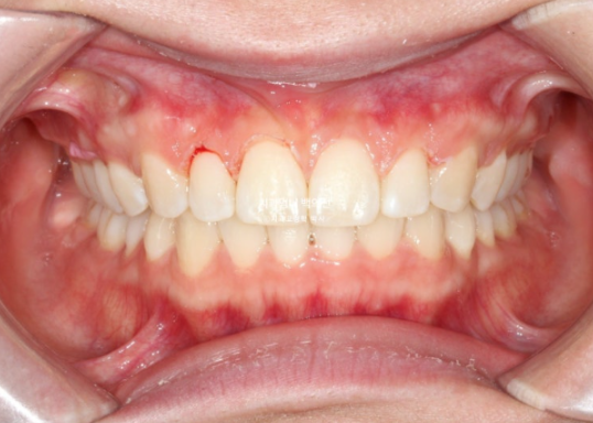 Inward-Tilted Teeth Orthodontic Treatment Review | Actual Case Improved with Non-Extraction Orthodontic Treatment for Gummy Smile, Deep Overbite & Gum Asymmetry — Gangnam Orthodontic Clinic image 10
