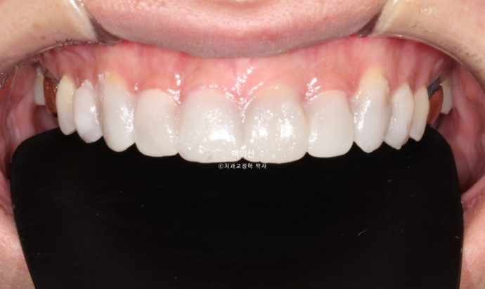 Treatment Review: No-Prep Laminate for Tetracycline-Stained Teeth image 12