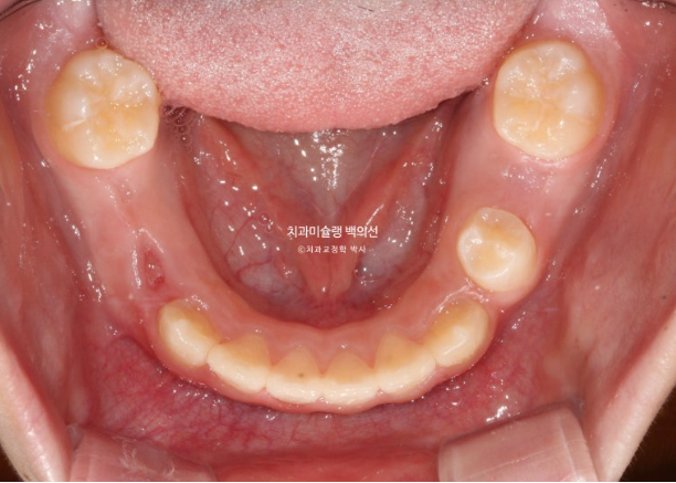 어린이 비대칭 반대교합 주걱턱 인비절라인 퍼스트 프리올소 성장 교정 관련 이미지 23