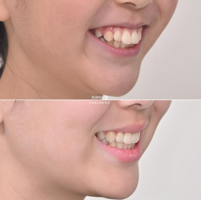 돌출입 비발치 어린이 교정 입술부전증 호두주름 호두턱 토끼이빨 인비절라인퍼스트 관련 이미지 21
