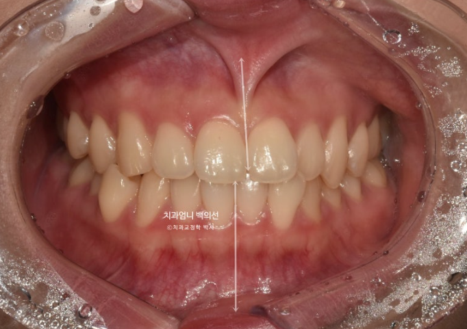 인비절라인 교정 비발치 비대칭 덧니 중심선 선천적 결손치 교정? 관련 이미지 2