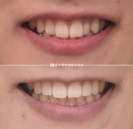 앞니 부분교정은 어떤 경우에 가능한가요? 단기 앞니 부분교정 왜소치 치료 무삭제 라미네이트 관련 이미지 14