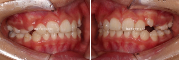 압구정 어린이교정 인비절라인 퍼스트 악궁확장 덧니 교정 관련 이미지 5