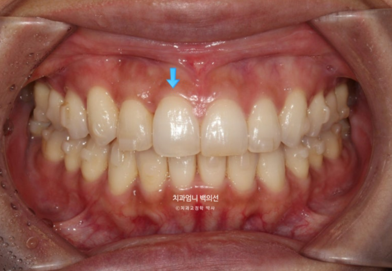 인비절라인 비발치 덧니 교정 반대교합 치료 후기 관련 이미지 11