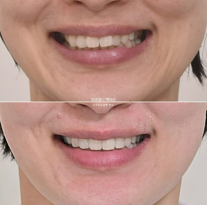 50대 치아교정 교합평면 기울어짐 토끼이 덧니 교정? 관련 이미지 12