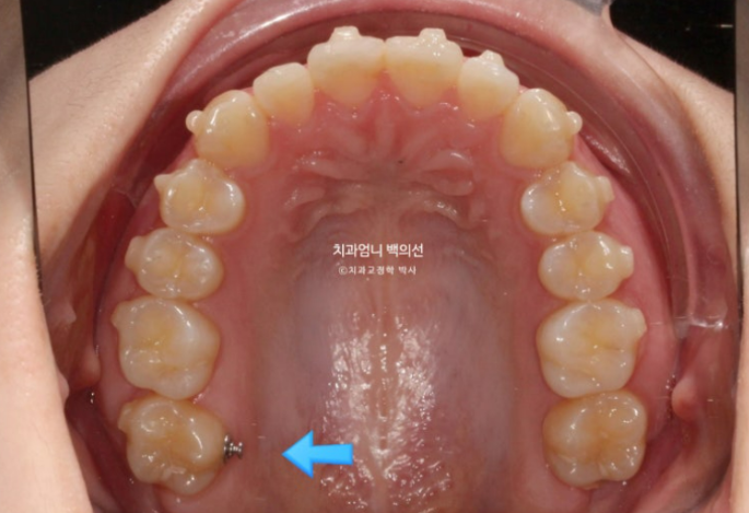 어금니 반대교합&middot;가위교합도 인비절라인 라이트로 교정할 수 있을까? 관련 이미지 10