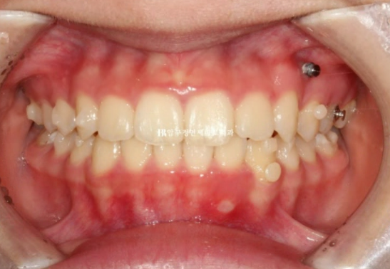 어린이 투명교정 인비절라인 틴 덧니 교정 후기 관련 이미지 7