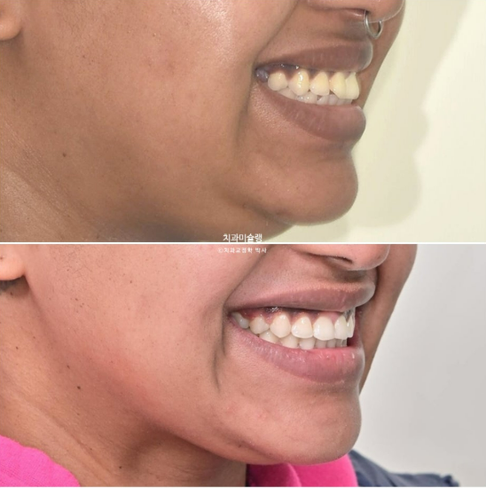 Extraction & re-orthodontics with Clippy-C, intrusion for dental implant. 관련 이미지 1