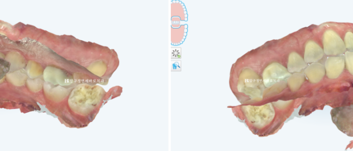 Invisalign Lite for Orthodontic Treatment in Your 40s: Crossbite and Protrusive Mouth Correction image 7