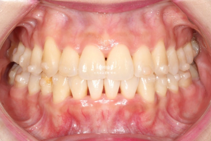 인비절라인 비발치 제2대구치 발치 사랑니 대체 교정 심한 덧니 교정 치료 관련 이미지 14