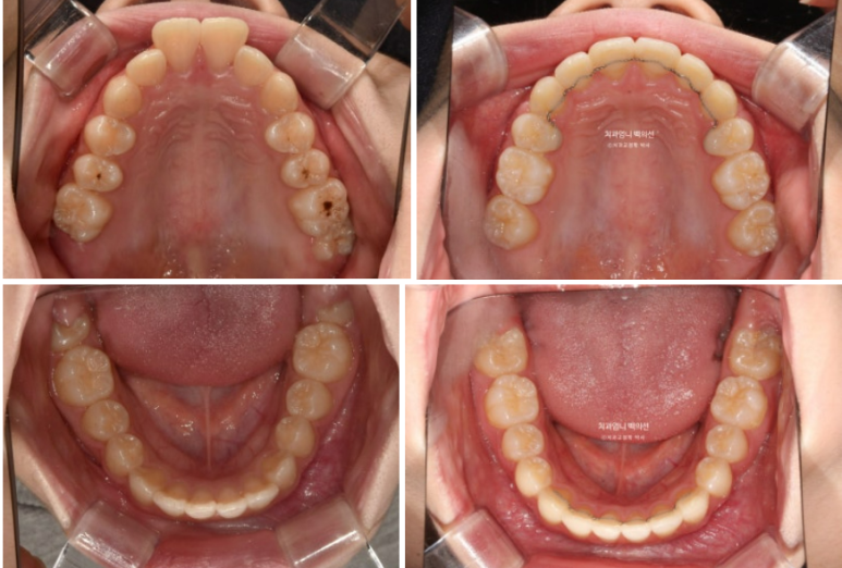 입이 안 다물어짐 입술부전증 호두턱 교정? 관련 이미지 12
