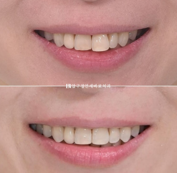 Can Invisalign Lite Work for Patients in Their 40s? A Real Case Improving Scissor Bite and Deep Bite in 10 Months image 19