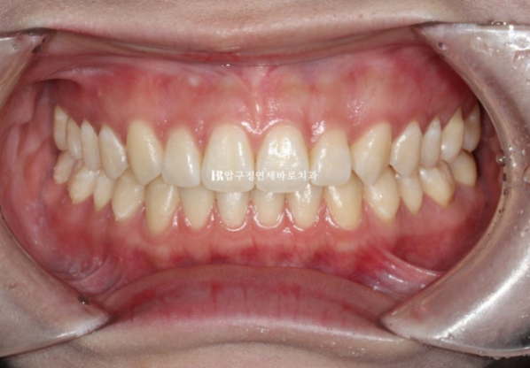 If Inward-Tilted Teeth Make Your Smile Look Constricted? Invisalign Before and After image 9