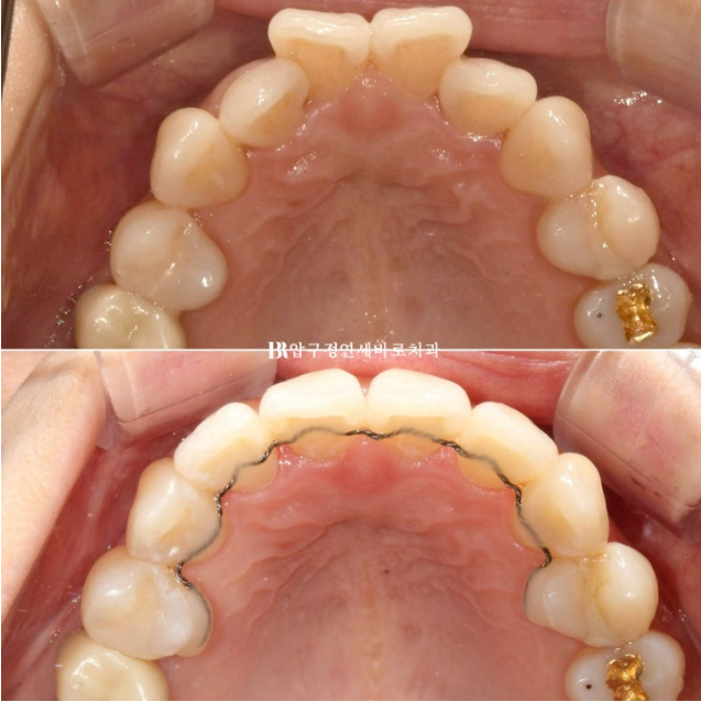 30대 토끼이빨 교정 반대교합 앞니 부분교정 후기 관련 이미지 10