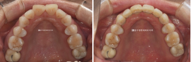 Can Invisalign Lite Work for People in Their 50s? A Real Middle-Aged Orthodontic Case Improving Butterfly Teeth and Gum Recession image 11