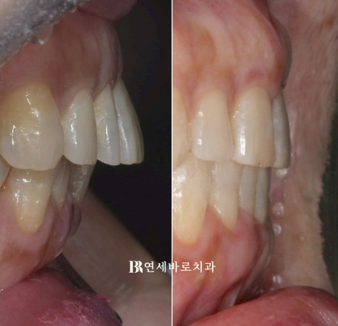 50대 치아벌어짐 단기 교정 가능할까요? 관련 이미지 6