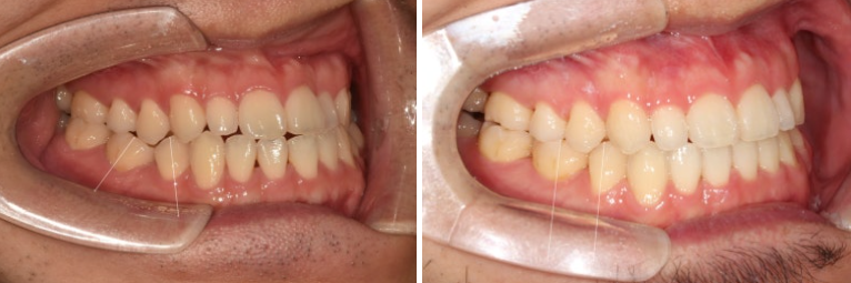 주걱턱 교정 반대교합 소구치 선천적 결손 부정교합 비발치 교정 후기 관련 이미지 10