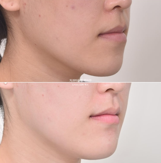 비수술 주걱턱 비대칭 발치 교정 결손치 반대교합 클리피씨 치료기간 1년 11개월 관련 이미지 18