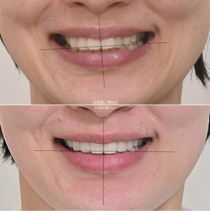 50대 치아교정 교합평면 기울어짐 토끼이 덧니 교정? 관련 이미지 14