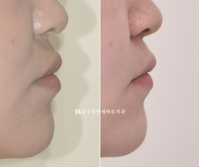 앞니 벌어짐 교정, 인비절라인이 더 잘 될까? 치아벌어짐 7개월 실제 사례 관련 이미지 10