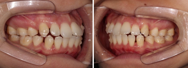 30대 돌출입 덧니 교정 인비절라인 발치교정 후기 관련 이미지 8