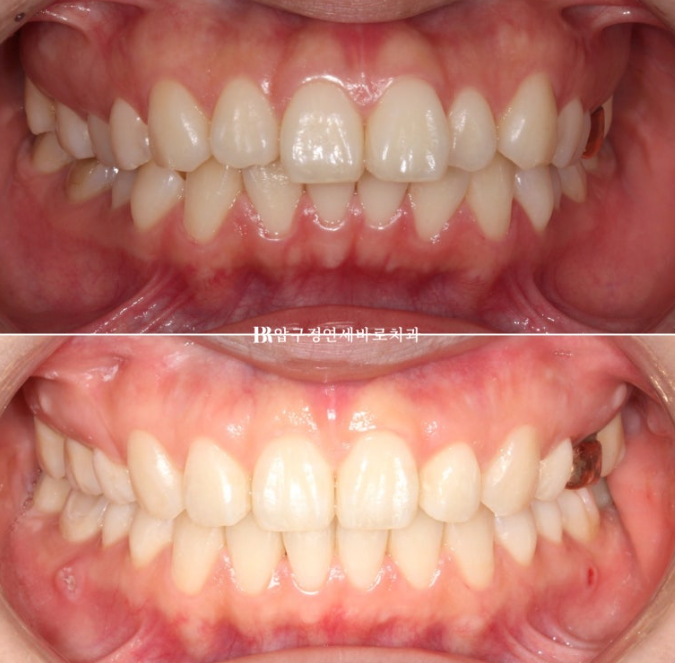 Gummy Smile Correction, Gummy Smile Orthodontics, Rabbit Teeth Correction image 11