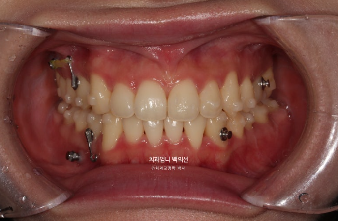인비절라인 교정 비발치 비대칭 덧니 중심선 선천적 결손치 교정? 관련 이미지 7